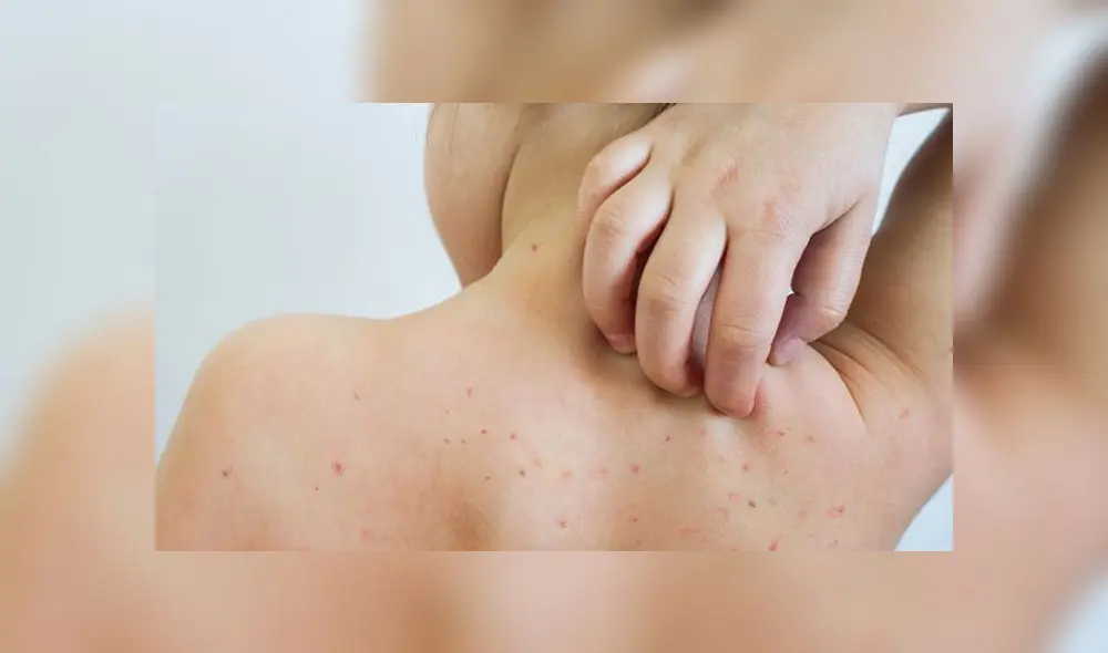 ¿Cómo distinguir entre el sarampión y la varicela?: Conoce las cinco diferencias