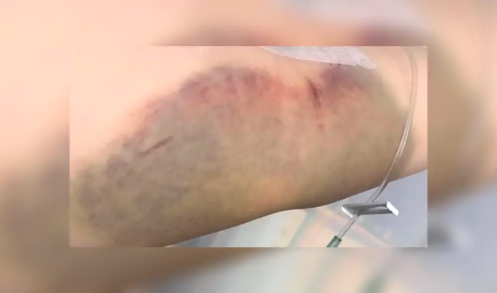 Le aparecieron varios moretones en el cuerpo, acude al médico, pero falleció unos días después [FOTOS] 