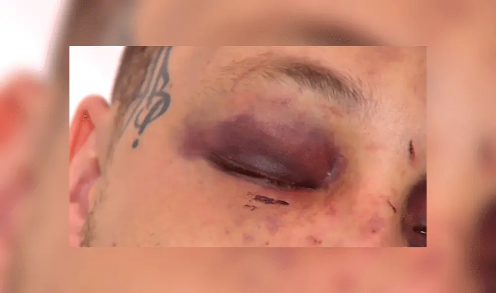 Queda con el rostro desfigurado tras defender a mujer maltratada por su pareja