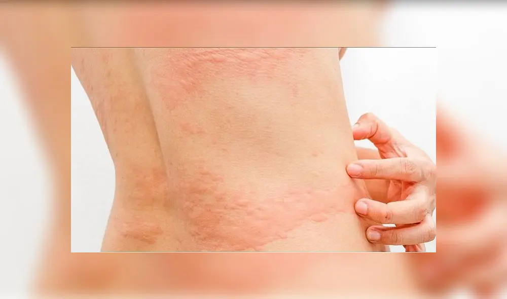 Varios pacientes con COVID-19 han presentado afecciones dermatológicas. Foto: AEDV Varios pacientes con COVID-19 han presentado afecciones dermatológicas. Foto: AEDV