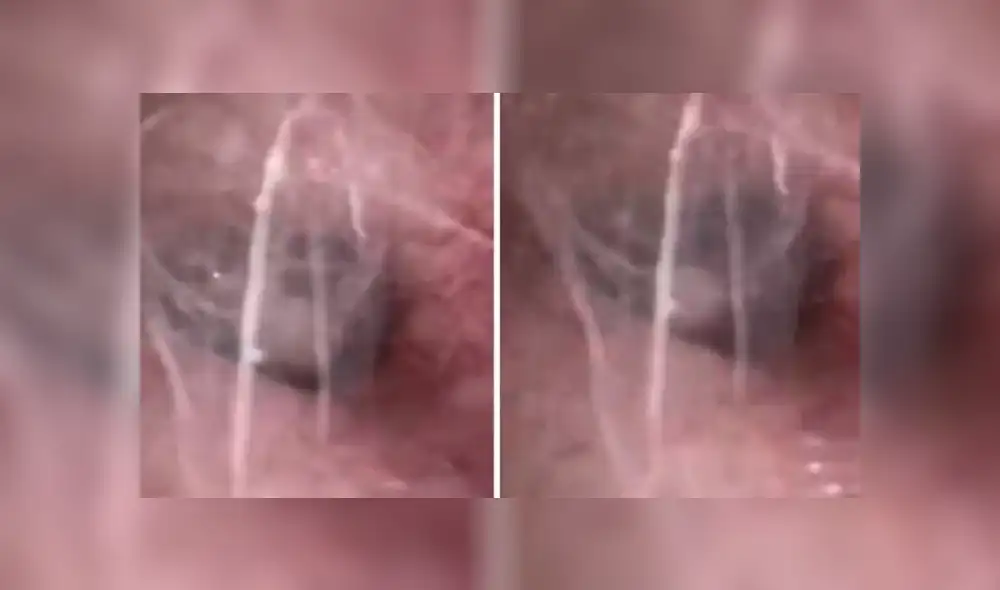 YouTube viral: médico revisa oído de joven y encuentra terrorífica criatura en su interior [VIDEO]