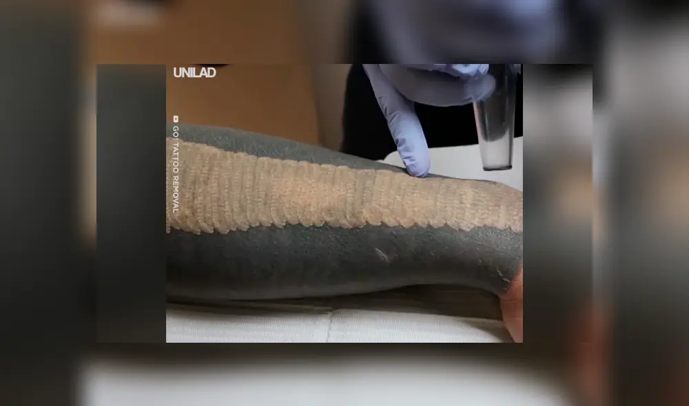 Facebook viral: joven decide quitarse tatuaje del brazo, sin imaginar el terrible resultado que tendría