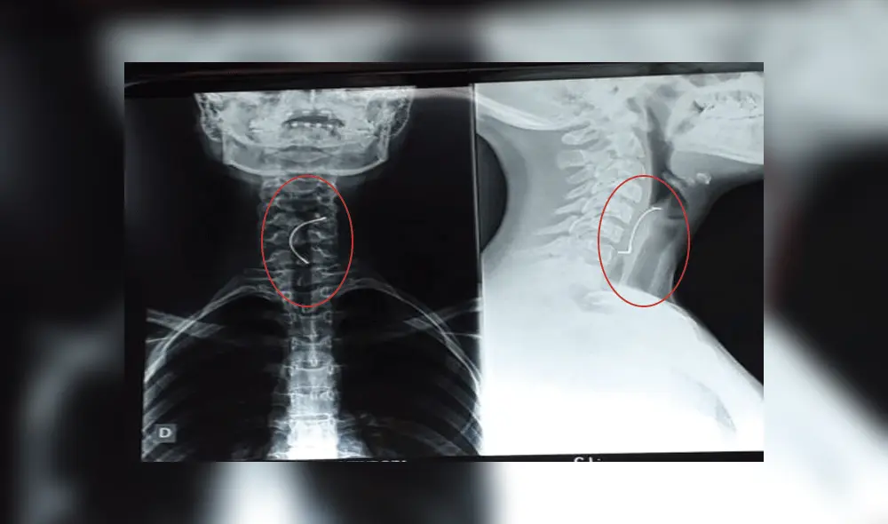 El expansor del paladar logró ser retirado. El expansor del paladar logró ser retirado.