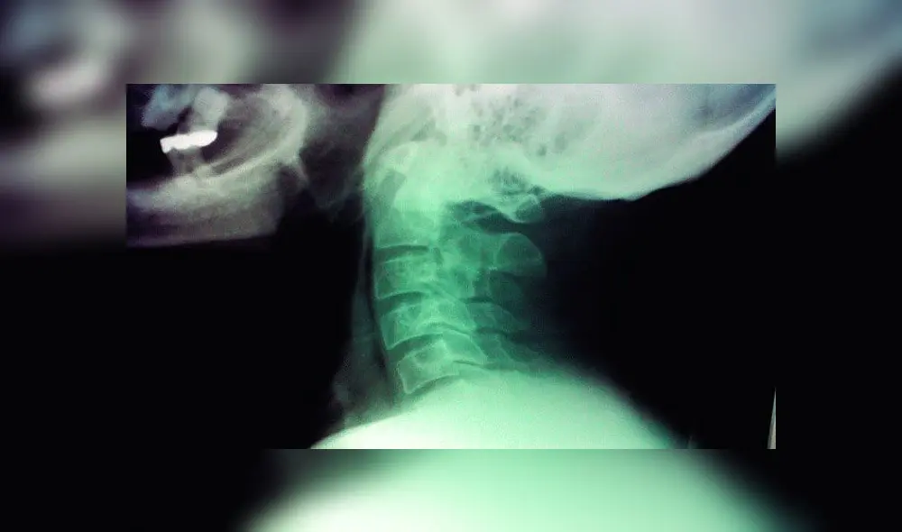 Radiografía de cuello humano. Foto: difusión Radiografía de cuello humano. Foto: difusión