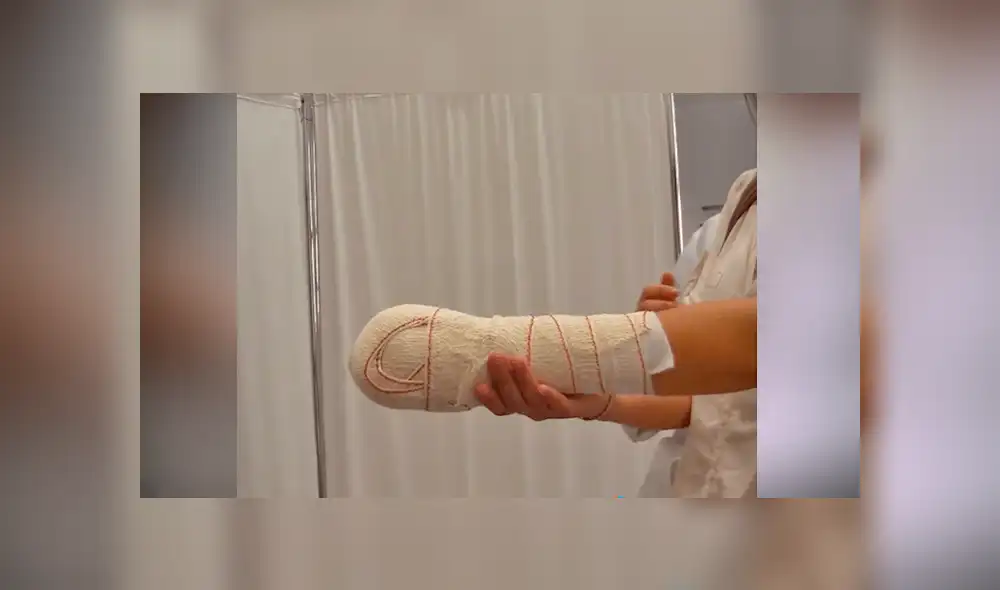 Mujer se amputa la mano con una sierra para cobrar casi 400.000 euros del seguro