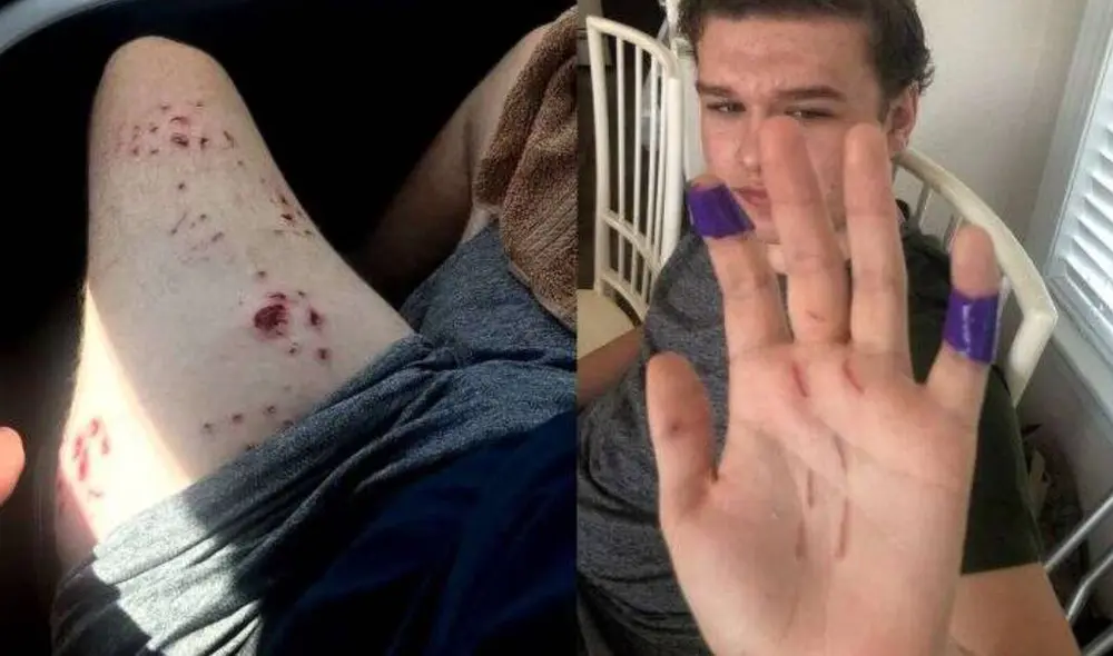 Nick sufrió heridas en su pierna y brazo tras el ataque del tiburón. Foto: Arthur Family / FOX8 Nick sufrió heridas en su pierna y brazo tras el ataque del tiburón. Foto: Arthur Family / FOX8