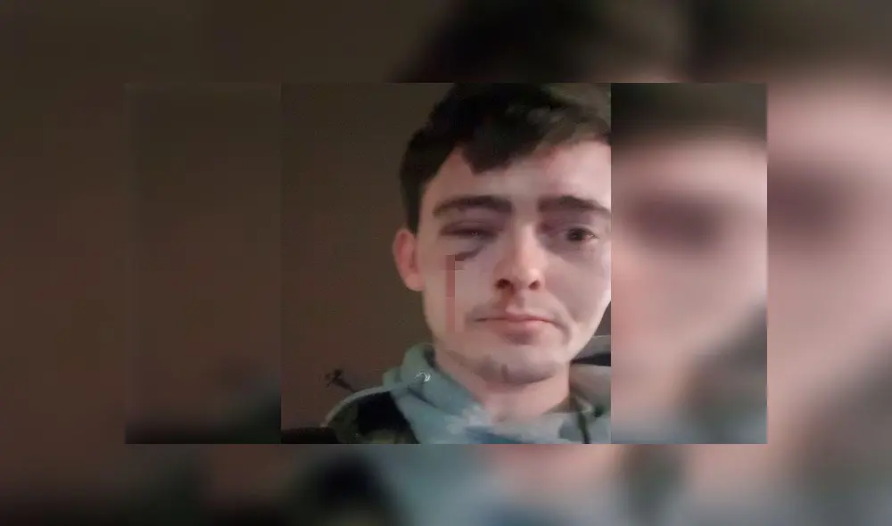 Queda con lesiones alrededor de los ojos tras recibir brutal agresión de ladrones Queda con lesiones alrededor de los ojos tras recibir brutal agresión de ladrones