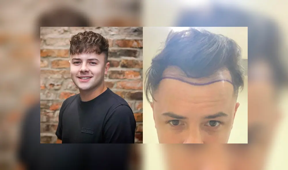 Luke sufría de calvicie en 2018 y se sometió a un trasplante capilar, pero quedó peor. Foto: The Sun Luke sufría de calvicie en 2018 y se sometió a un trasplante capilar, pero quedó peor. Foto: The Sun