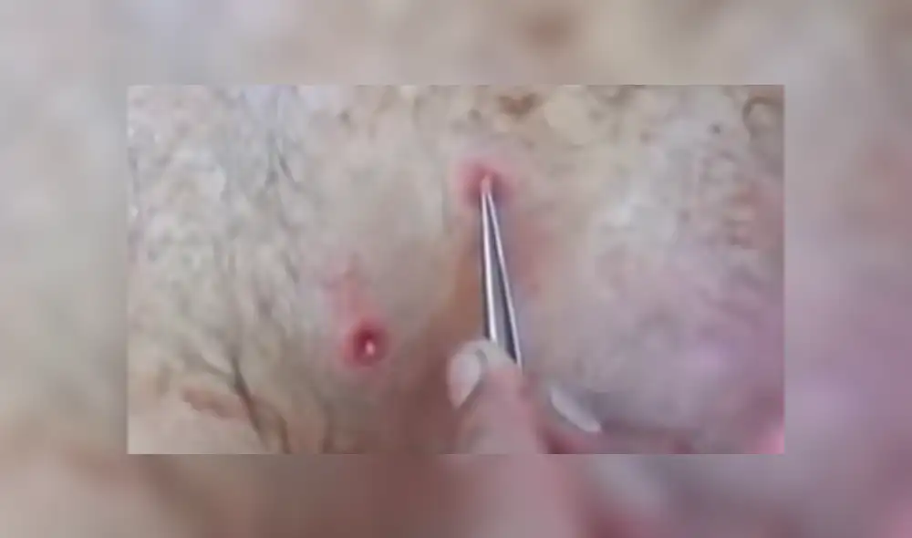 Facebook viral: misteriosas criaturas vivían dentro de la espalda de un joven sin que él lo sepa [VIDEO]