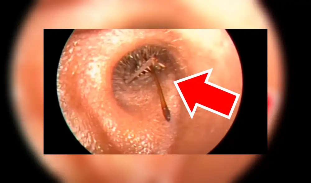 YouTube viral: médico encuentra 'misteriosa criatura' dentro de oído que genera terror [VIDEO]