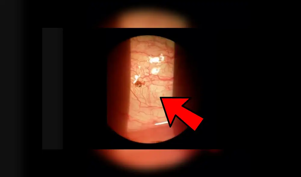 El bicho hizo un ruido como un pequeño estallido cuando la retiraron. Foto: captura