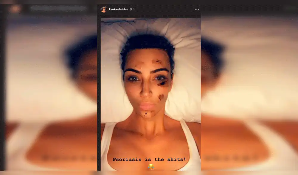Kim Kardashian muestra impactantes imágenes del efecto de la psoriasis Kim Kardashian muestra impactantes imágenes del efecto de la psoriasis