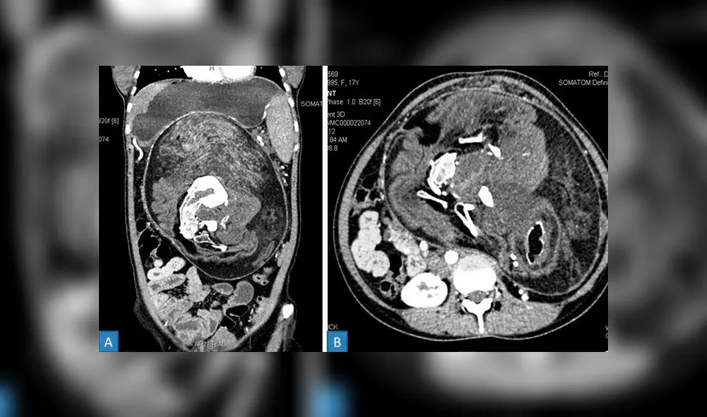 Tomografía computarizada del abdomen de la joven. Se puede ver a la compleja masa de su 'gemelo'. Imagen: BMF Case Reports. Tomografía computarizada del abdomen de la joven. Se puede ver a la compleja masa de su 'gemelo'. Imagen: BMF Case Reports.
