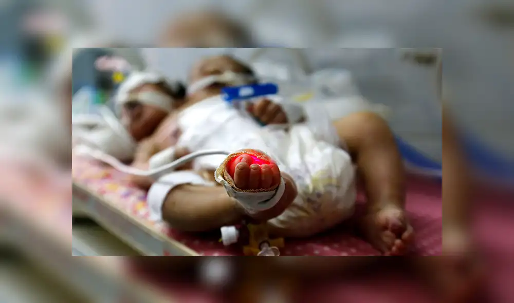 Bebés siameses mueren en Yemen al no recibir tratamiento [VIDEO]