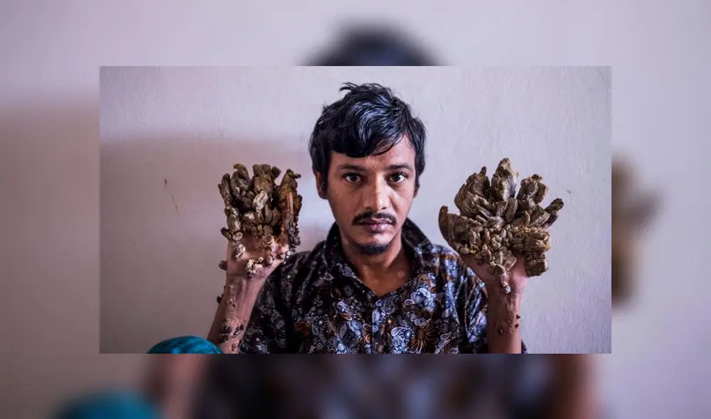 Abul Bajandar fue conocido en 2016 como el 'hombre árbol' y hoy hace triste pedido. Foto: AFP Abul Bajandar fue conocido en 2016 como el 'hombre árbol' y hoy hace triste pedido. Foto: AFP