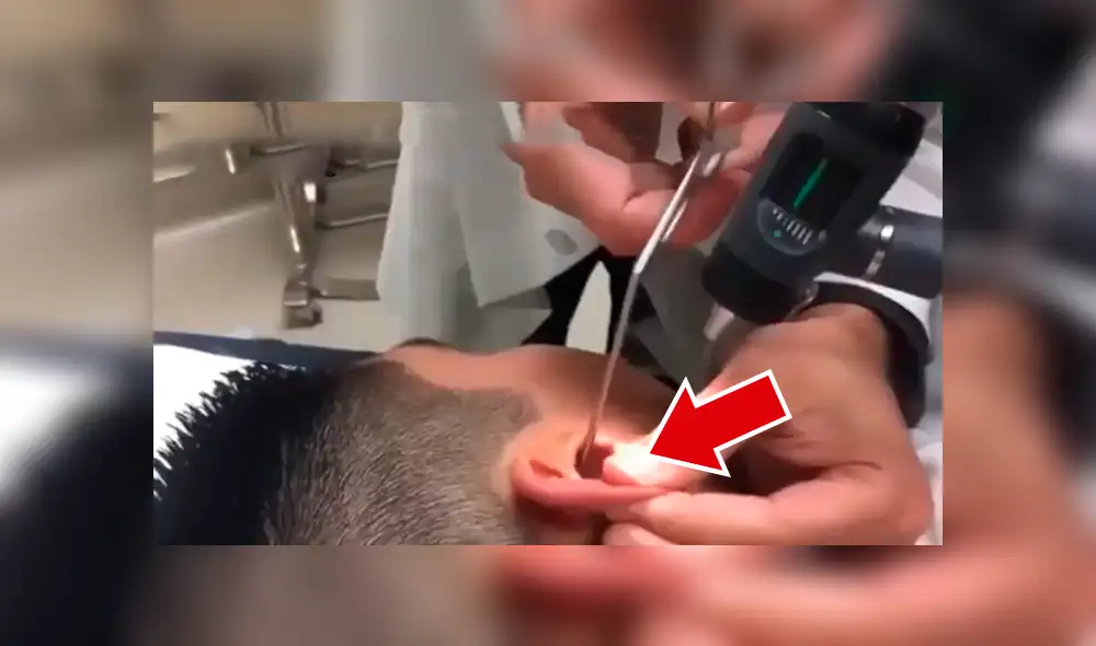 Facebook viral: nunca imaginarás la aterradora criatura que encontró este joven dentro de su oído [VIDEO] 