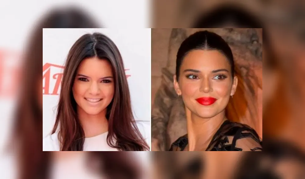 Kendall Jenner, antes y después de cirugías. Kendall Jenner, antes y después de cirugías.