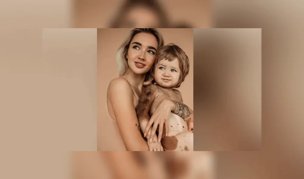 Bebé nace con extraña enfermedad en la piel y su madre influencer lo presume con orgullo [FOTOS]