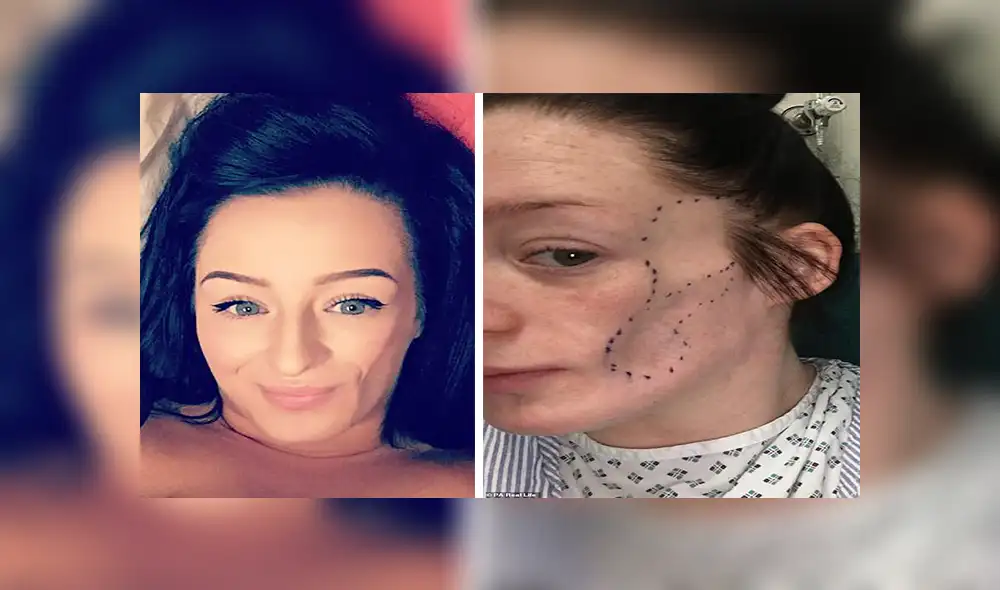 Rara enfermedad obligó a mujer a reconstruirse el rostro con grasa de su estómago 