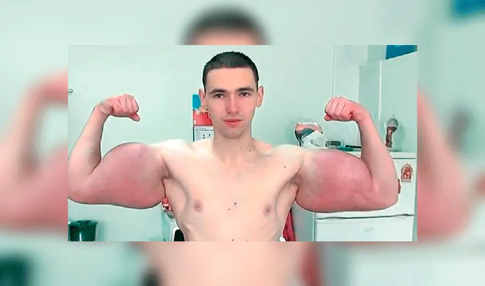 Qué es el Synthol, la peligrosa sustancia que se inyectó el “Popeye” ruso para aumentar sus músculos [VIDEO]