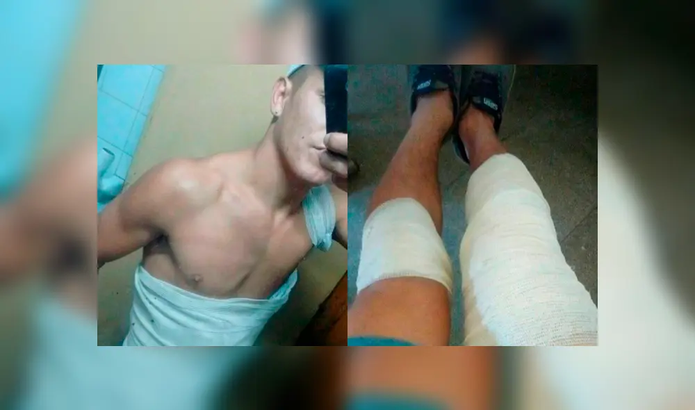 El joven quedó con graves quemaduras luego que el líquido ácido de la batería se impregnara en su cuerpo. (Foto: Facebook) El joven quedó con graves quemaduras luego que el líquido ácido de la batería se impregnara en su cuerpo. (Foto: Facebook)