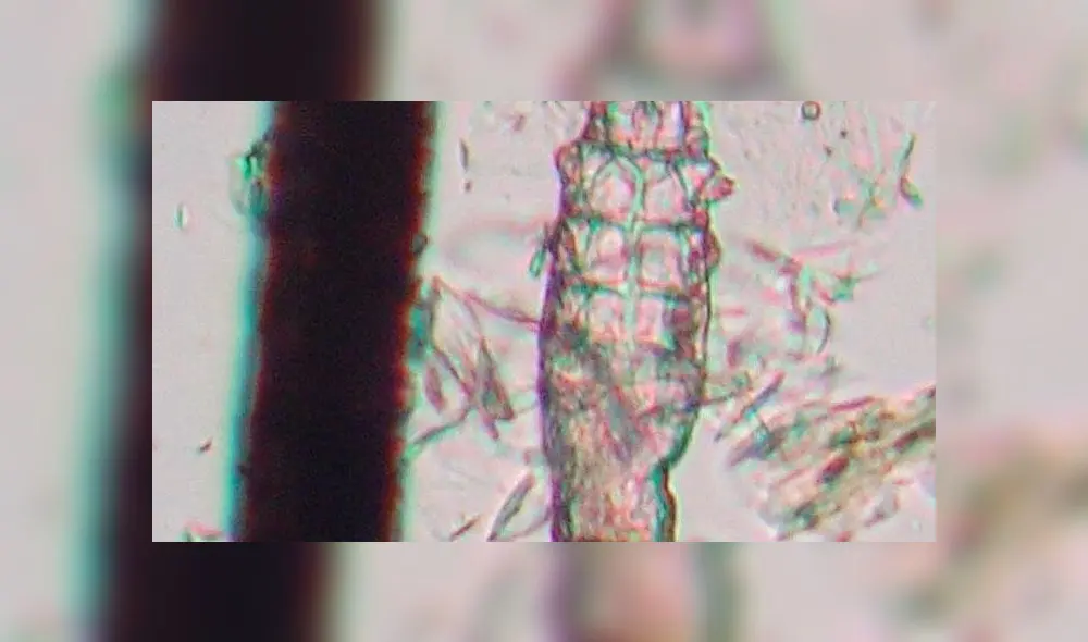 Demodex:  el ácaro que vive y se reproduce en el rostro ¿es una amenaza?