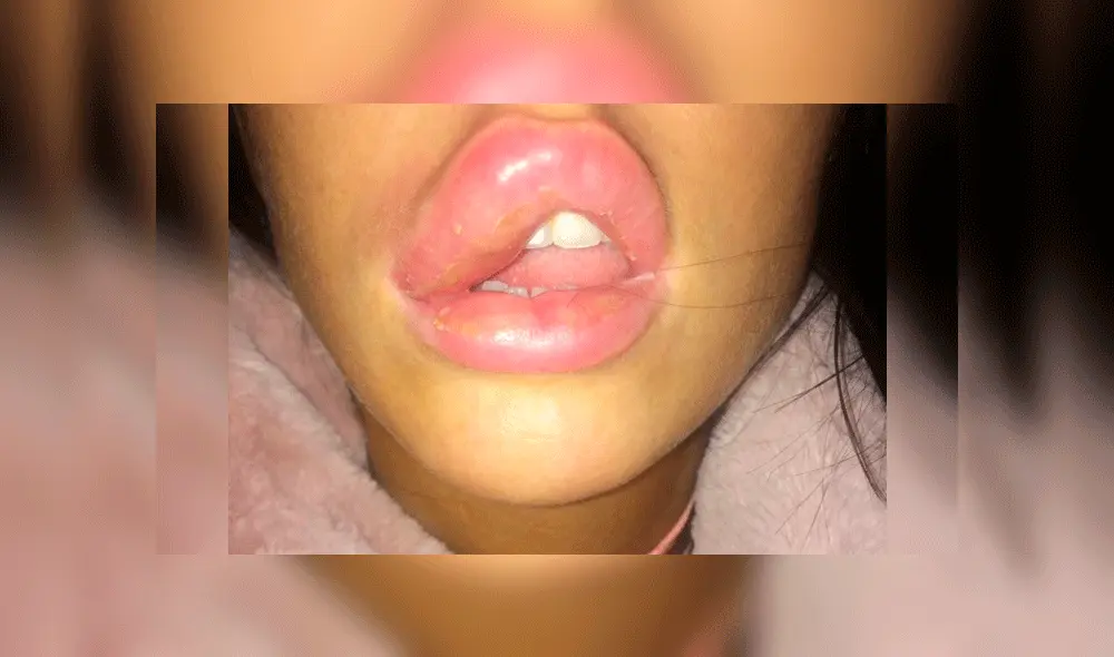 Su labio operado reventó y casi queda ciega por la pus que saltó a su ojo