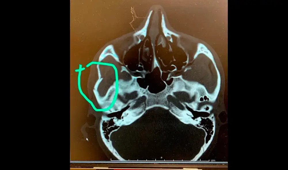 Zlatan Ibrahimovic le provocó una fractura de cráneo a un rival en la MLS. | Foto: @AmroAbdelAziz Zlatan Ibrahimovic le provocó una fractura de cráneo a un rival en la MLS. | Foto: @AmroAbdelAziz