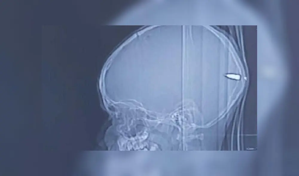 Una imagen de rayos x muestra la bala alojada en el cerebro del niño de nueve años. Foto: Hospital Universitario Hadassah (The Times of Israel)