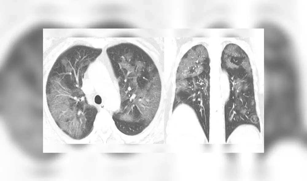 Tomografías muestran el daño que causa el coronavirus en los pulmones