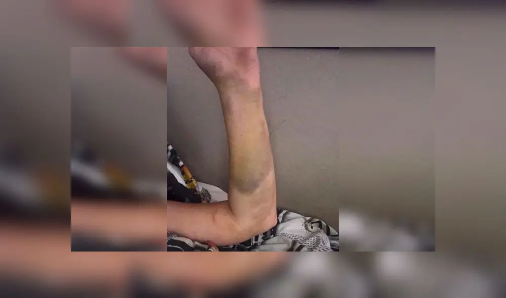 Mujer casi muere debido a dos coágulos que le surgieron por tomar un anticonceptivo Mujer casi muere debido a dos coágulos que le surgieron por tomar un anticonceptivo