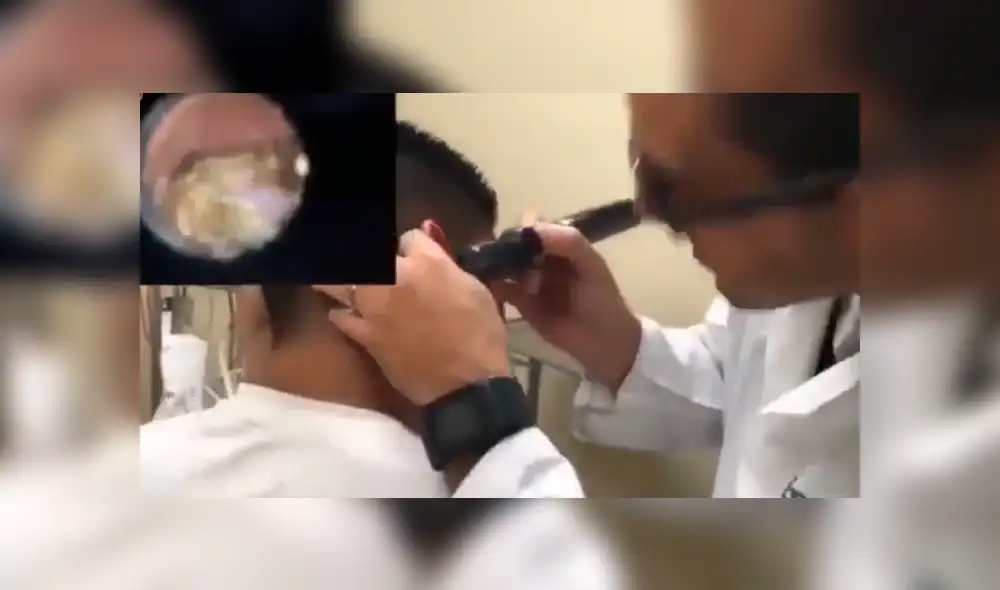 Facebook viral: nunca imaginarás la aterradora criatura que encontró este joven dentro de su oído [VIDEO] 