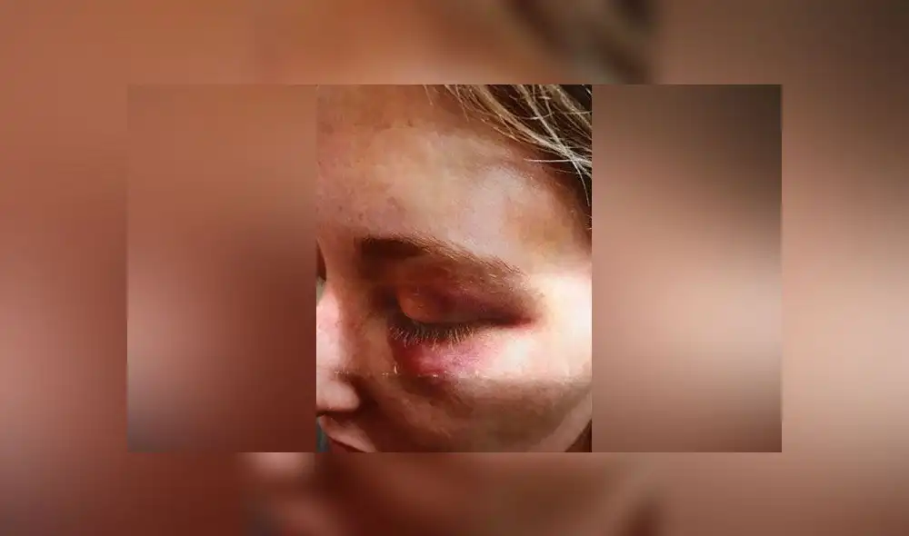 Perdonó a su esposo por brutal golpiza y en víspera de Navidad la volvió a masacrar [FOTOS] 