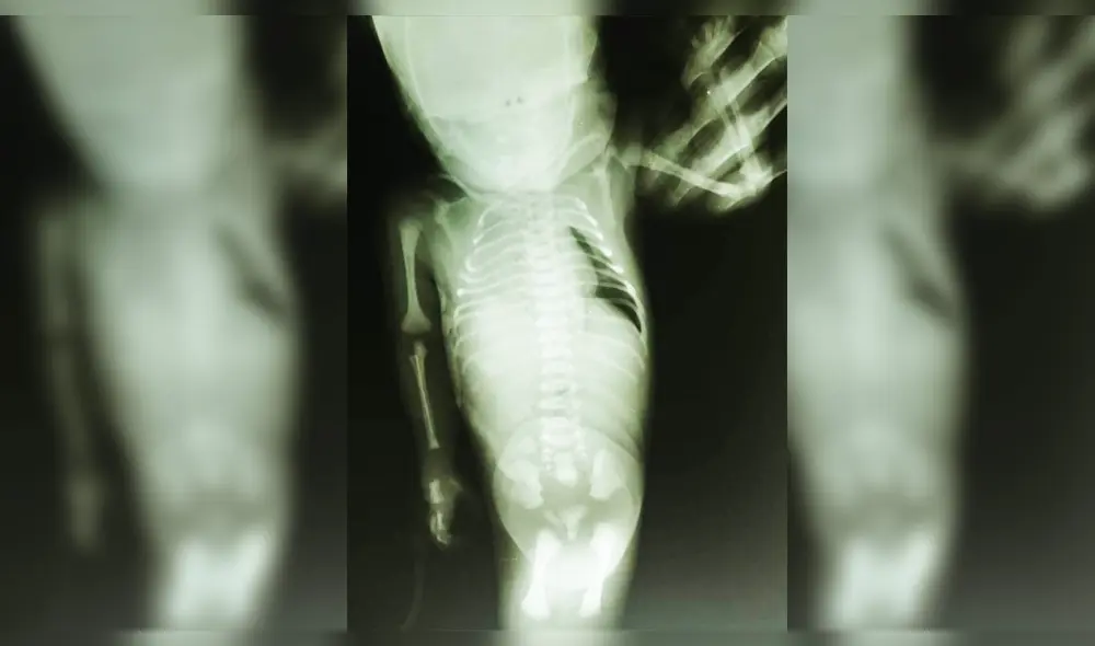 Esta sería la radiografía practicada a la pequeña.