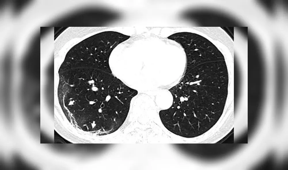 Tomografías muestran el daño que causa el coronavirus en los pulmones [FOTOS]