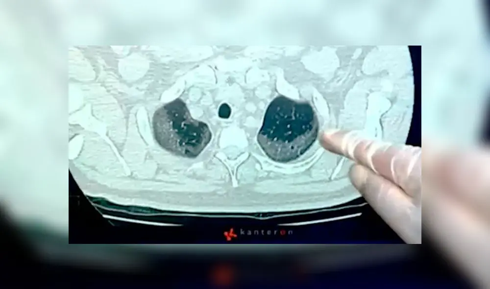 EsSalud muestra imágenes de cómo el coronavirus contamina a los pulmones. EsSalud muestra imágenes de cómo el coronavirus contamina a los pulmones.
