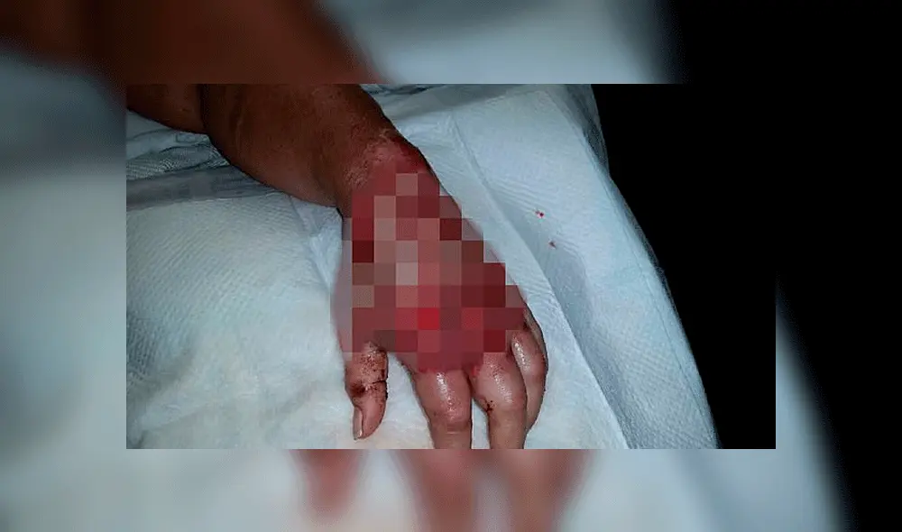 Contrajo bacteria carnívora al cortarse con un papel y quedó cerca de morir