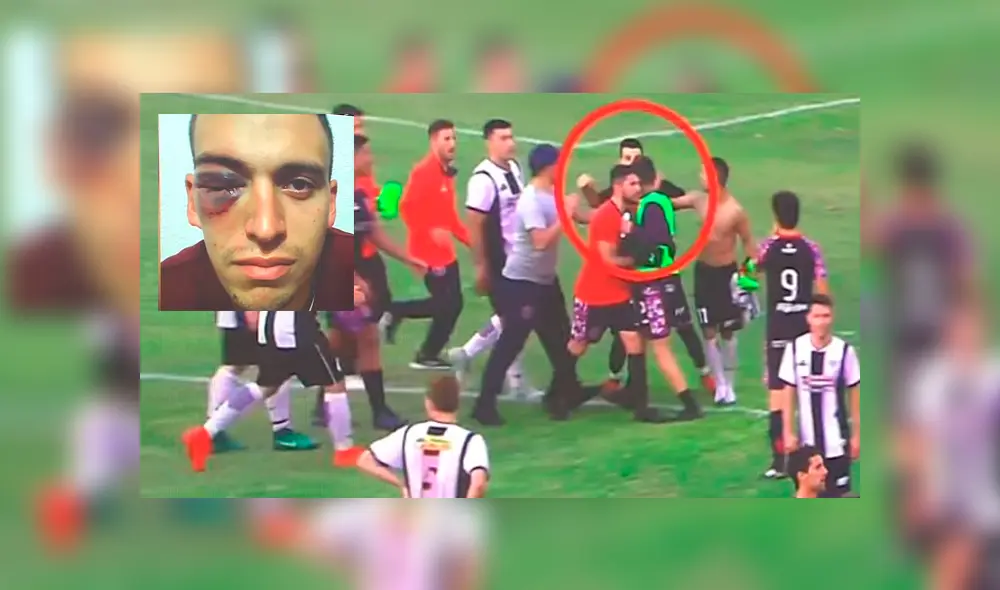 Arquero recibió brutal golpe en la cara y terminó con un edema en la retina [VIDEO]