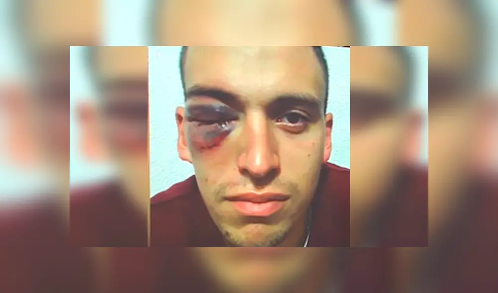 Arquero recibió brutal golpe en la cara y terminó con un edema en la retina [VIDEO]
