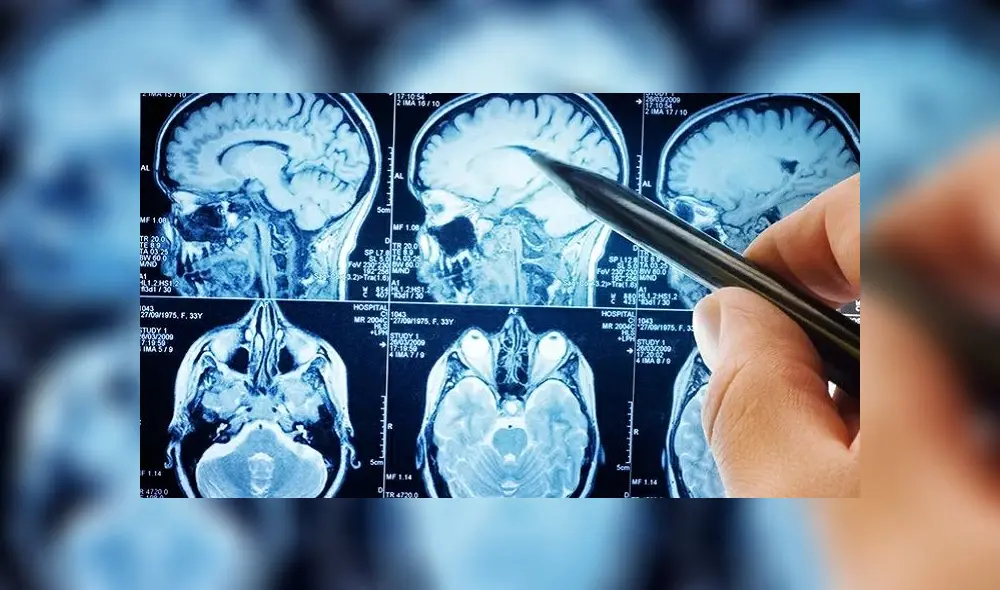 Tomografía de un cerebro con accidente cerebrovascular. Foto: Sutterstock Tomografía de un cerebro con accidente cerebrovascular. Foto: Sutterstock