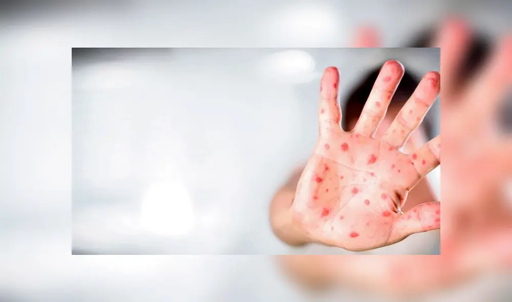 Sarampión: ¿qué es, cuáles son las causas y cómo prevenir esta enfermedad viral?