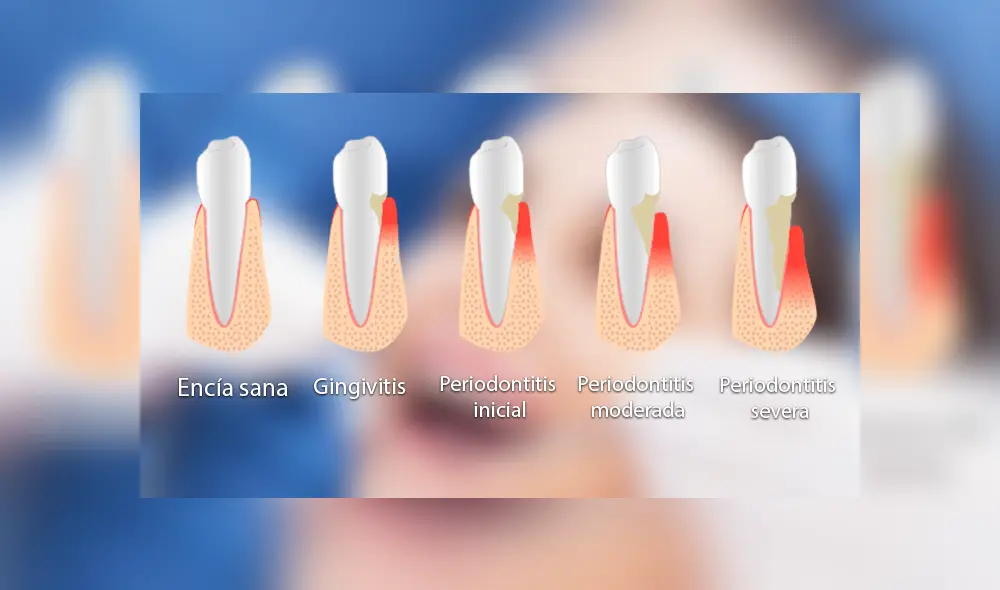 ¿Cómo se genera la gingivitis y cuál es el tratamiento?