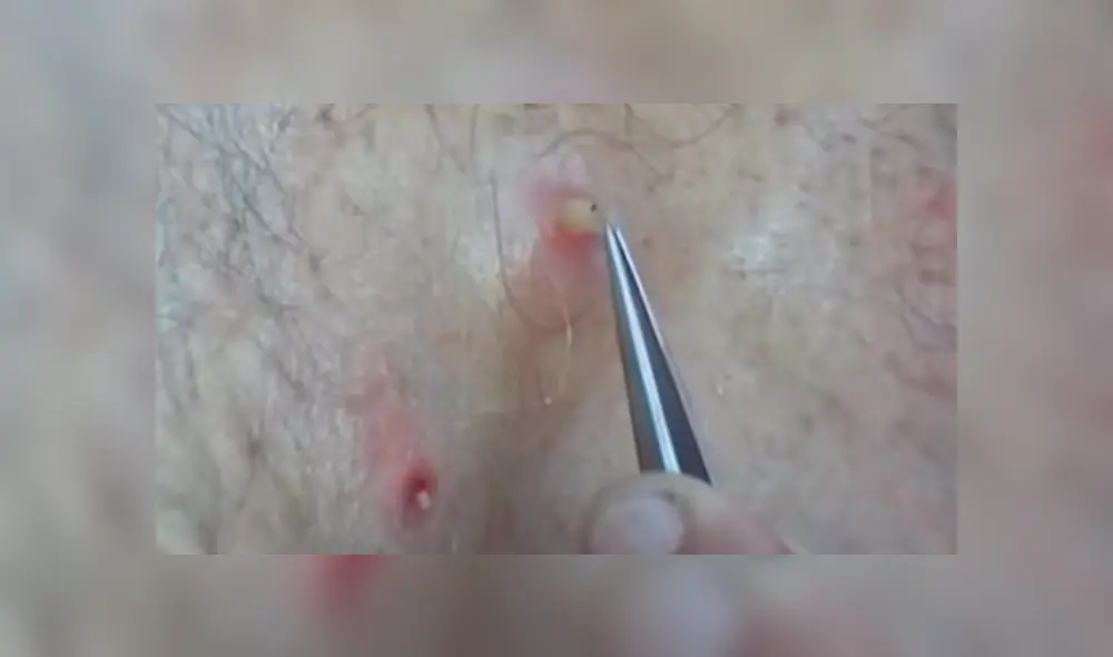 YouTube viral: joven va al médico por roncha en su espalda y le hacen espeluznante hallazgo [VIDEO]