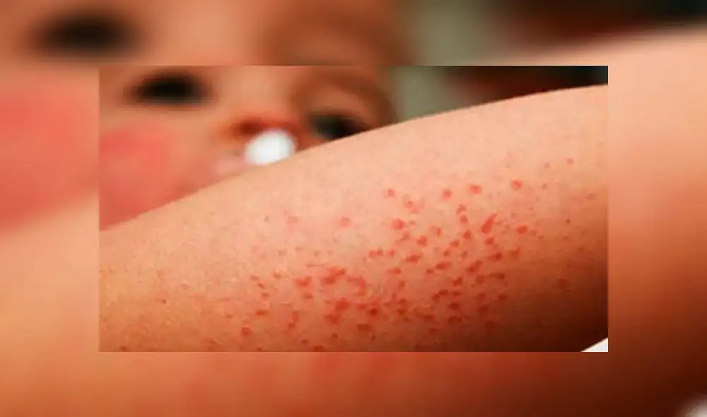 Alerta sanitaria en cuatro países de Europa por brote de sarampión 