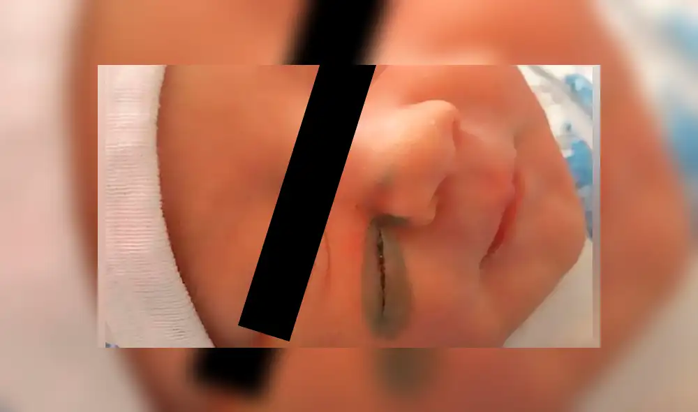 Un bebé recién nacido quedó desfigurado después de que los médicos lo cortaran accidentalmente durante una cesárea. (Foto: Referencial)