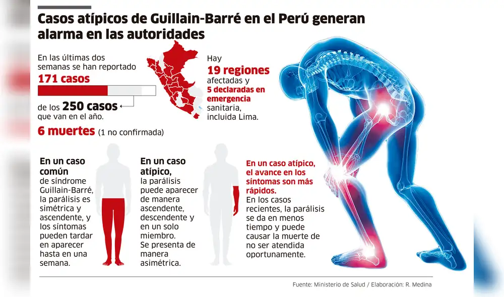 Casos atípicos de Guillain-Barré en el Perú generan alarma en las autoridades [INFOGRAFÍA]