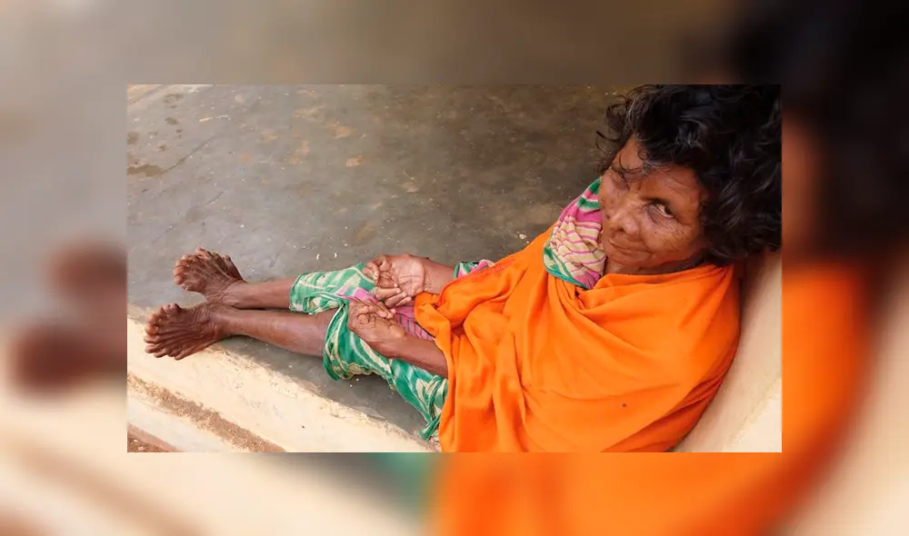 La anciana nació con 19 dedos en los pies y 12 en las manos. Una extraña enfermedad que la ha convertido en el centro de burlas y discriminación en un pueblo de la India. La anciana nació con 19 dedos en los pies y 12 en las manos. Una extraña enfermedad que la ha convertido en el centro de burlas y discriminación en un pueblo de la India.