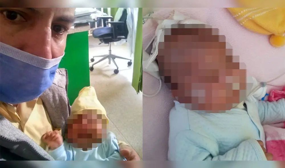 bebe hidrocefalia bebe hidrocefalia