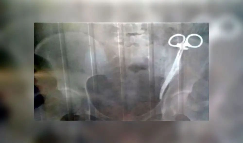 Mujer tiene tijeras quirúrgicas en su abdomen desde hace 23 años