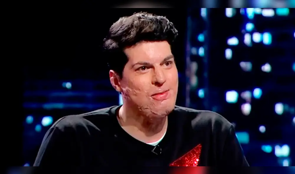 Exchico reality mostró cómo quedó su cuerpo tras sobrevivir al 90% de quemaduras en accidente